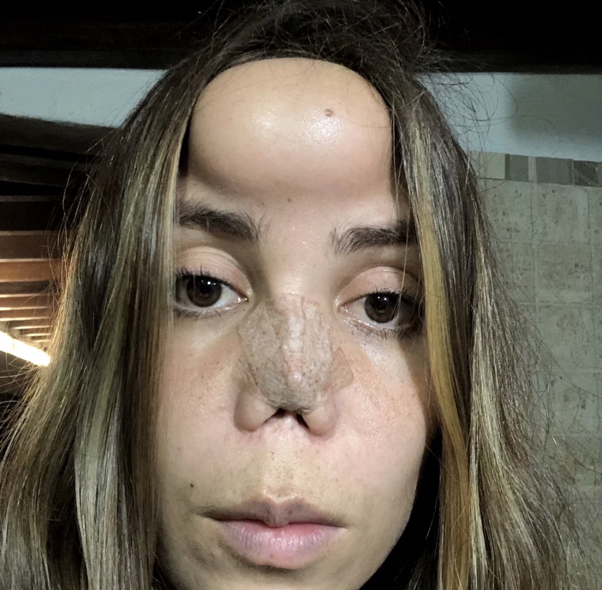 Months later — visible scarring across forehead, brow and nose
