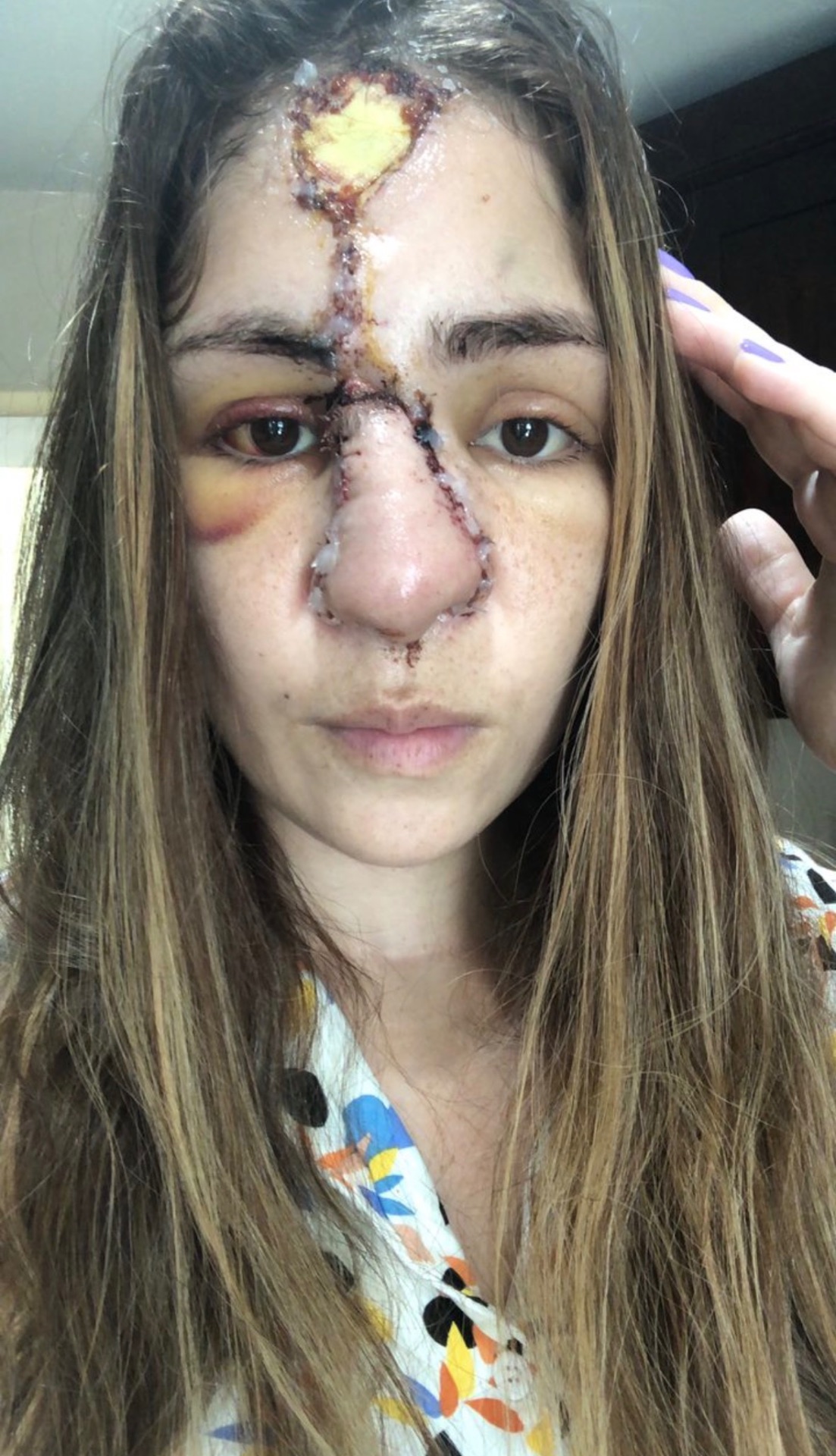 Healing through the forehead flap reconstruction process