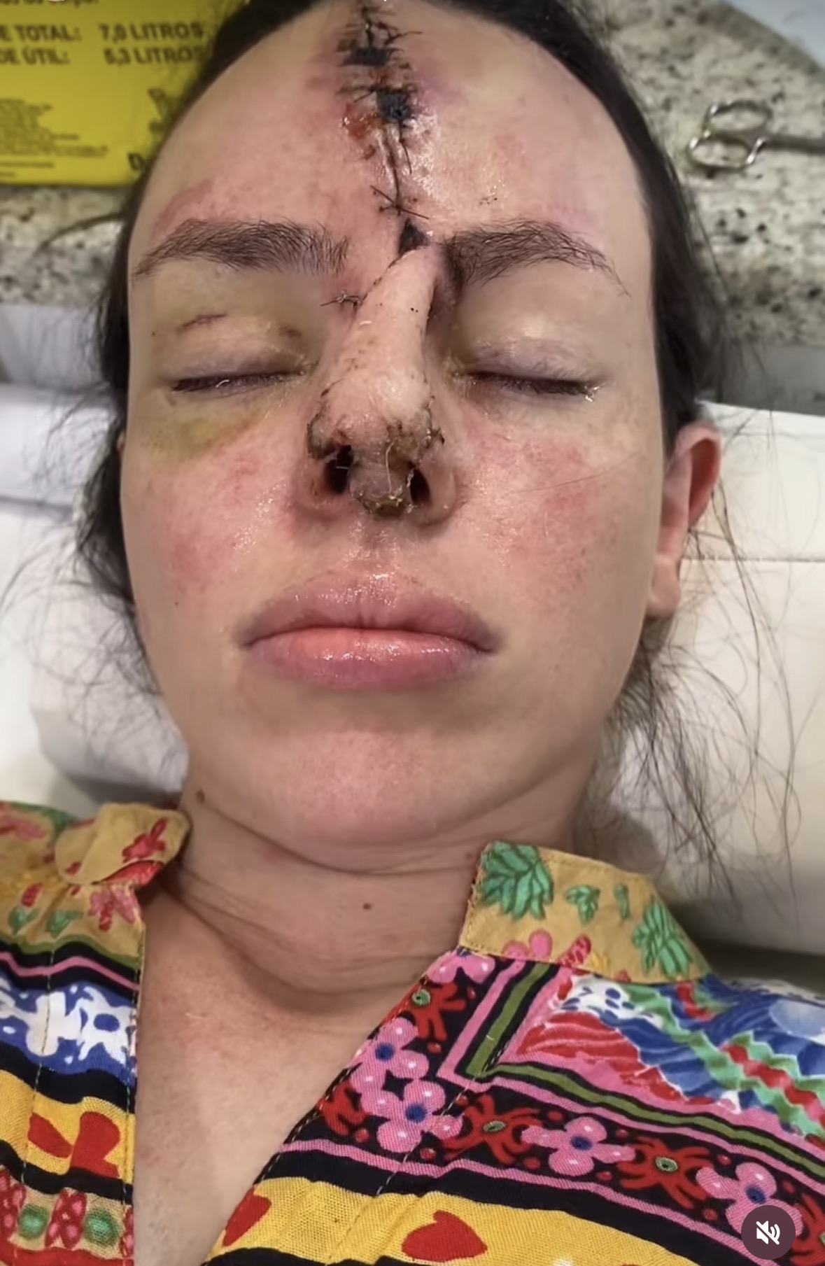 Mid-reconstruction — forehead flap pedicle still attached