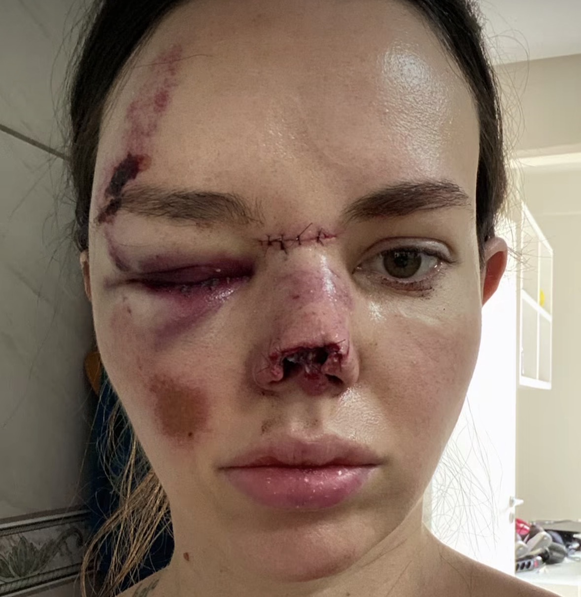 Early post-op bruising and sutures from reconstructive surgery