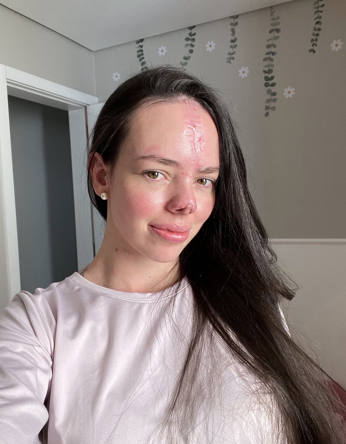 Healed — pink forehead scar still visible after reconstruction